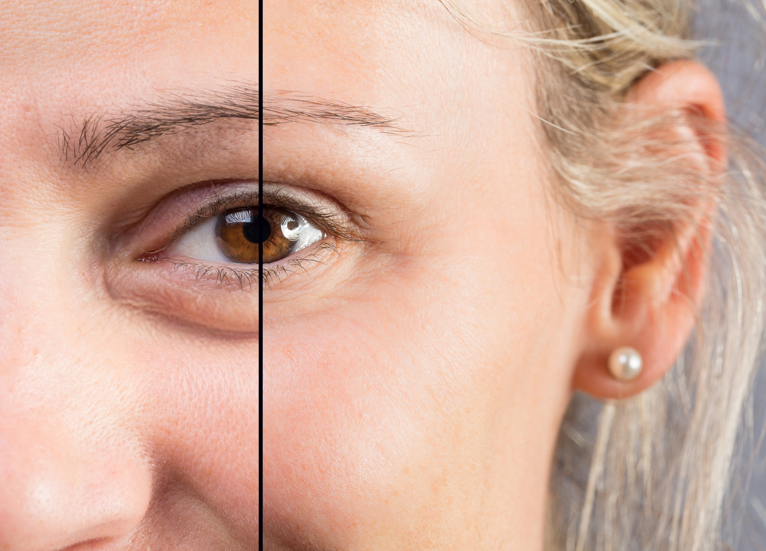 Under-eye rejuvenation