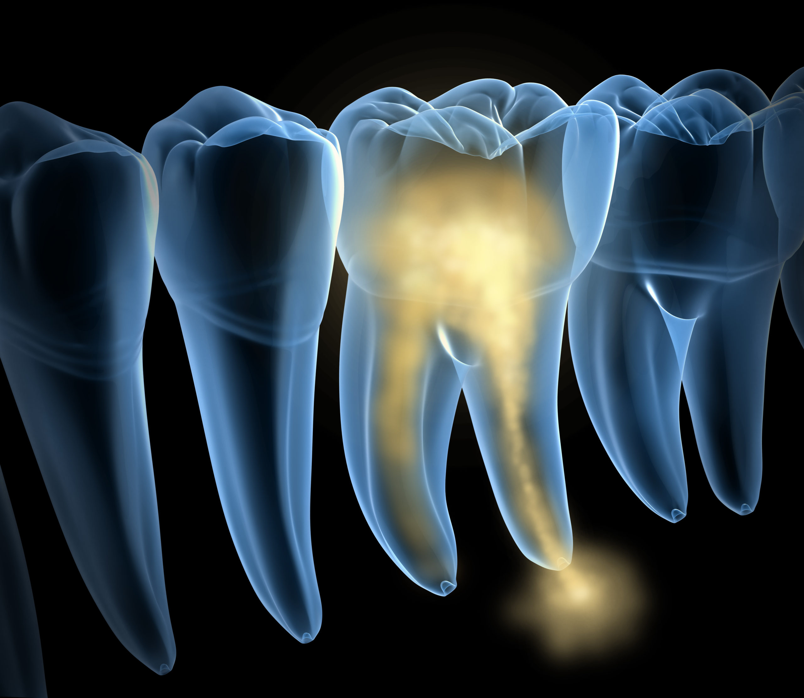 Tooth Nerve Damage