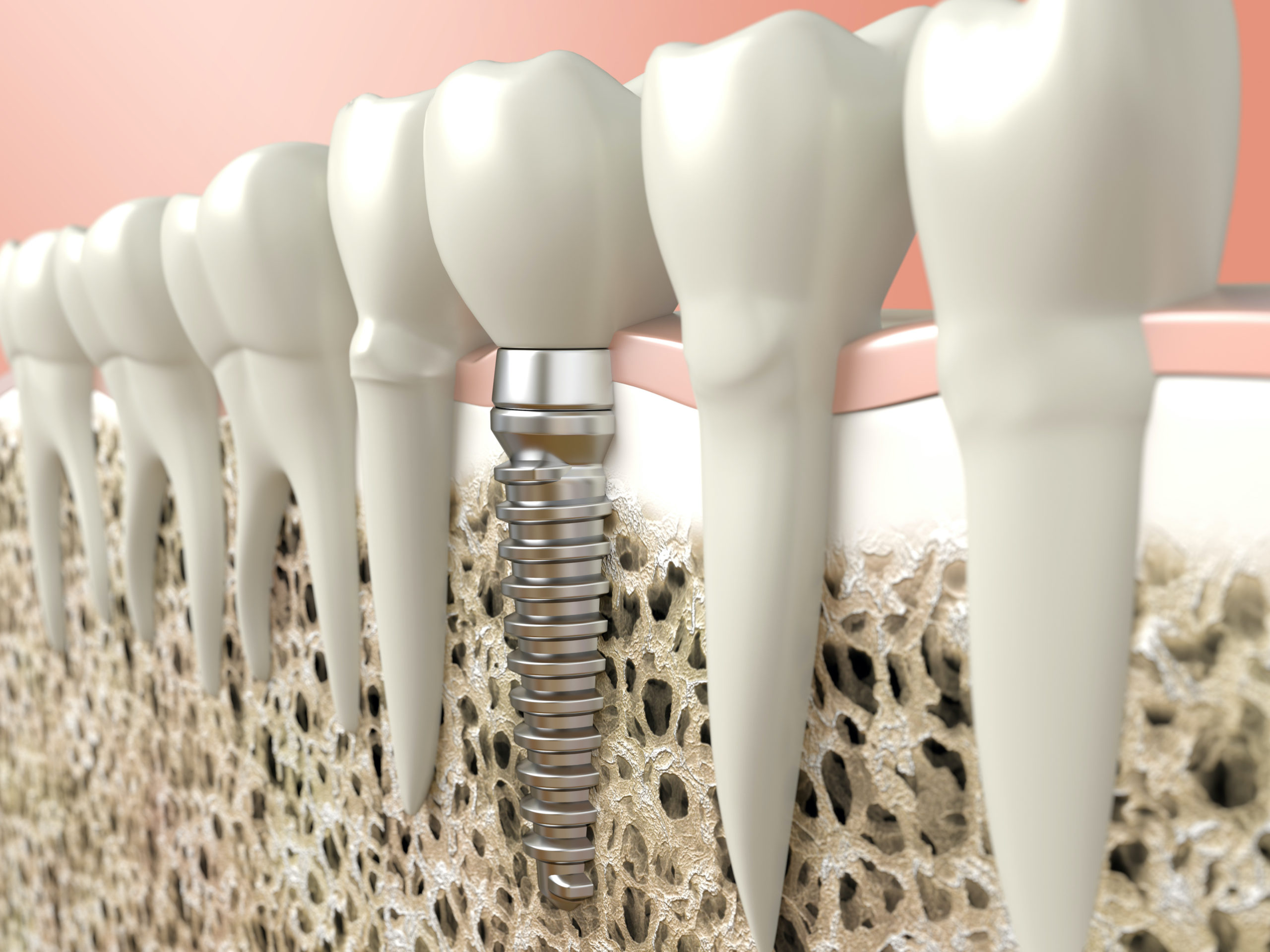 bone grafting implant