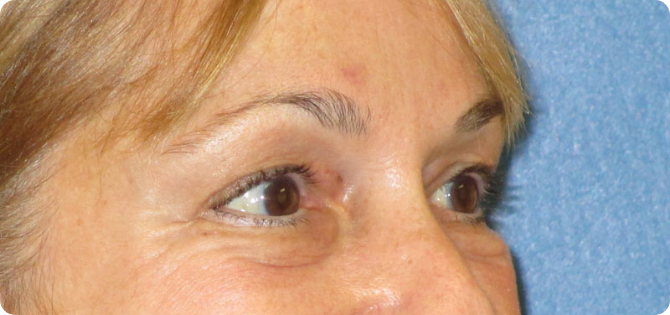 internal_browlift_bawidget_after