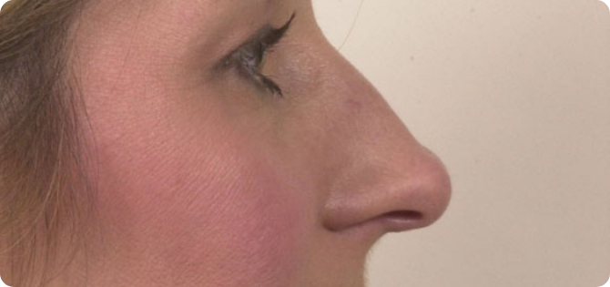 internal_rhinoplasty_bawidget_after