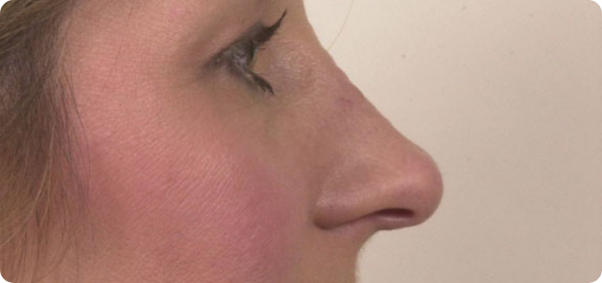 internal_rhinoplasty_bawidget_before