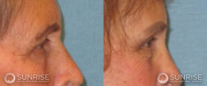 sunriseoral_assets_beforeandafters_browlift-patient-11a