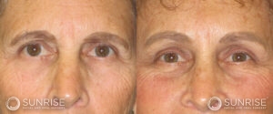 sunriseoral_assets_beforeandafters_browlift-patient-11b