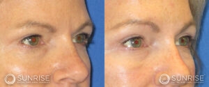 sunriseoral_assets_beforeandafters_browlift-patient-1b