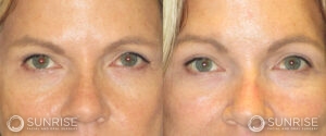 sunriseoral_assets_beforeandafters_browlift-patient-1c