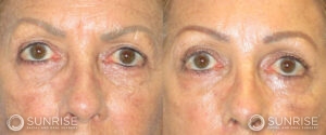 sunriseoral_assets_beforeandafters_browlift-patient-3a