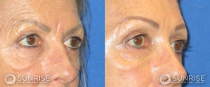 sunriseoral_assets_beforeandafters_browlift-patient-3b