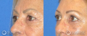 sunriseoral_assets_beforeandafters_browlift-patient-3c