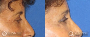 sunriseoral_assets_beforeandafters_browlift-patient-4a