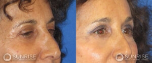 sunriseoral_assets_beforeandafters_browlift-patient-4b