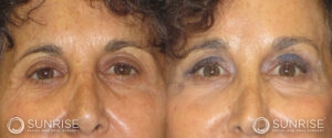 sunriseoral_assets_beforeandafters_browlift-patient-4c