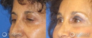 sunriseoral_assets_beforeandafters_browlift-patient-4d