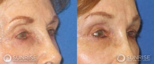 sunriseoral_assets_beforeandafters_browlift-patient-5b