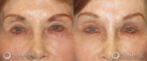 sunriseoral_assets_beforeandafters_browlift-patient-5c