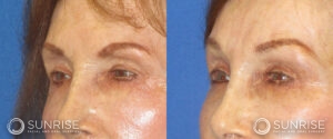 sunriseoral_assets_beforeandafters_browlift-patient-5d