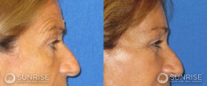 sunriseoral_assets_beforeandafters_browlift-patient-6a