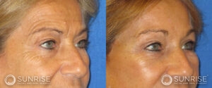 sunriseoral_assets_beforeandafters_browlift-patient-6b