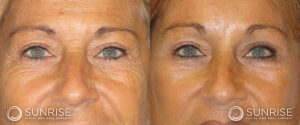 sunriseoral_assets_beforeandafters_browlift-patient-6c