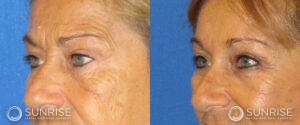 sunriseoral_assets_beforeandafters_browlift-patient-6d