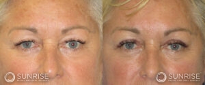 sunriseoral_assets_beforeandafters_browlift-patient-7c