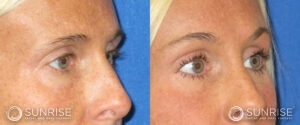 sunriseoral_assets_beforeandafters_browlift-patient-8a