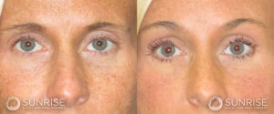 sunriseoral_assets_beforeandafters_browlift-patient-8b