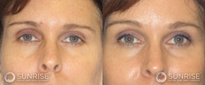 sunriseoral_assets_beforeandafters_browlift-patient-9b