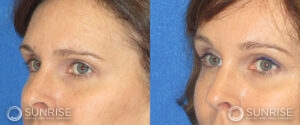 sunriseoral_assets_beforeandafters_browlift-patient-9c