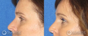 sunriseoral_assets_beforeandafters_browlift-patient-9d