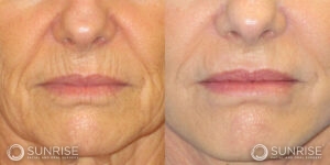 sunriseoral_assets_beforeandafters_dermalfillers-patient-1a