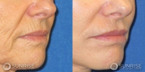 sunriseoral_assets_beforeandafters_dermalfillers-patient-1b