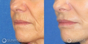 sunriseoral_assets_beforeandafters_dermalfillers-patient-1c