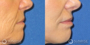 sunriseoral_assets_beforeandafters_dermalfillers-patient-1d