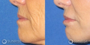 sunriseoral_assets_beforeandafters_dermalfillers-patient-1e