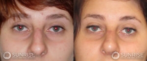 sunriseoral_assets_beforeandafters_rhinoplasty-1-a