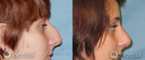 sunriseoral_assets_beforeandafters_rhinoplasty-1-b