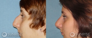 sunriseoral_assets_beforeandafters_rhinoplasty-1-c