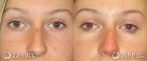 sunriseoral_assets_beforeandafters_rhinoplasty-4-a