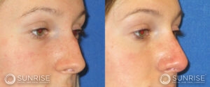 sunriseoral_assets_beforeandafters_rhinoplasty-4-b