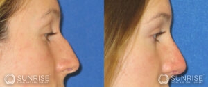 sunriseoral_assets_beforeandafters_rhinoplasty-4-c