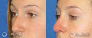 sunriseoral_assets_beforeandafters_rhinoplasty-4-d