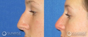 sunriseoral_assets_beforeandafters_rhinoplasty-4-e