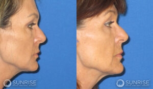 sunriseoral_assets_beforeandafters_sculptra_patient3c