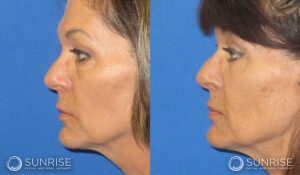 sunriseoral_assets_beforeandafters_sculptra_patient3e