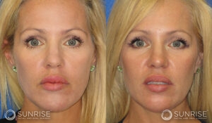 sunriseoral_assets_beforeandafters_sculptra_patient4a