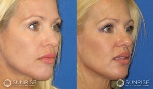 sunriseoral_assets_beforeandafters_sculptra_patient4b