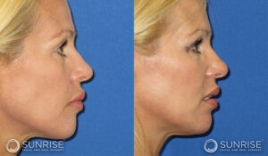 sunriseoral_assets_beforeandafters_sculptra_patient4c