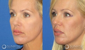 sunriseoral_assets_beforeandafters_sculptra_patient4d