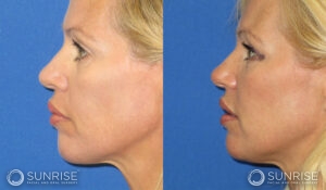 sunriseoral_assets_beforeandafters_sculptra_patient4e